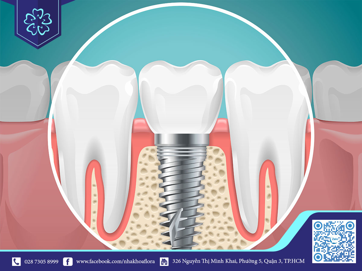trong-rang-su-implant trong-rang-su-implant