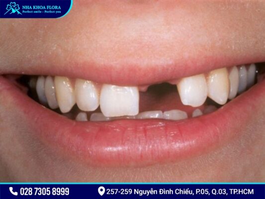 Trồng răng cửa - ảnh 1 Trồng răng cửa - ảnh 1