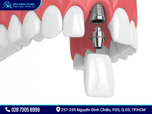 Trồng răng cửa - ảnh 2 Trồng răng cửa - ảnh 2
