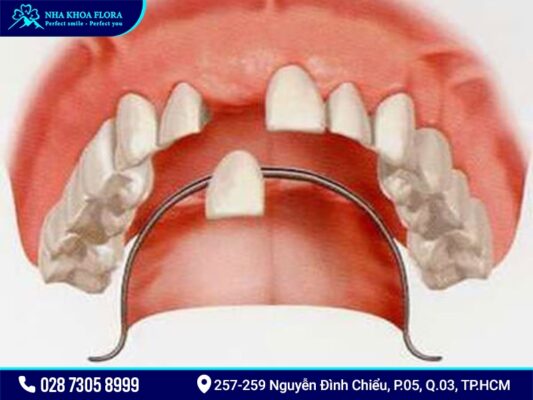 Trồng răng cửa - ảnh 3 Trồng răng cửa - ảnh 3