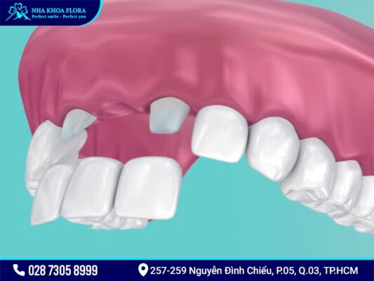 Trồng răng cửa - ảnh 4 Trồng răng cửa - ảnh 4