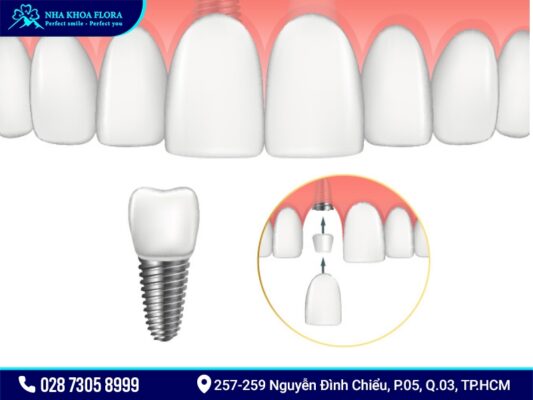 Trồng răng cửa - ảnh 5 Trồng răng cửa - ảnh 5