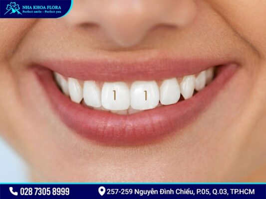 Trồng răng cửa - ảnh 6 Trồng răng cửa - ảnh 6