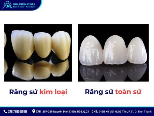 Răng sứ kim loại và răng toàn sứ - ảnh 1 Răng sứ kim loại và răng toàn sứ - ảnh 1