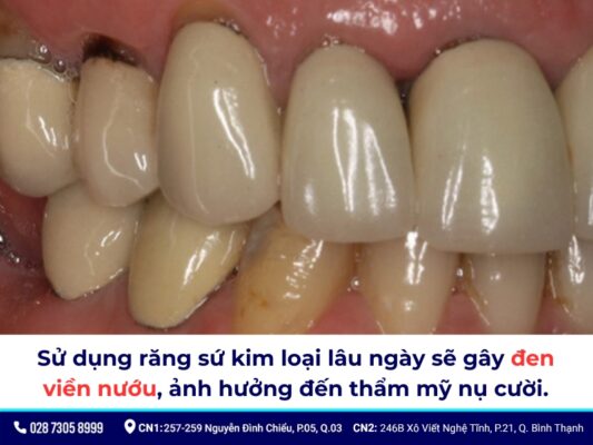 Tác hại của răng sứ kim loại - ảnh 5 Tác hại của răng sứ kim loại - ảnh 5