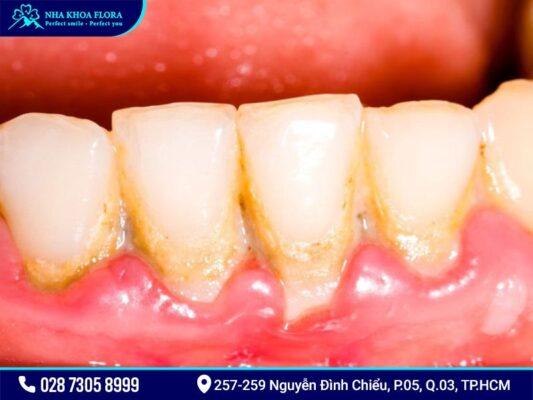 Tác hại của vôi răng - ảnh 1 Tác hại của vôi răng - ảnh 1