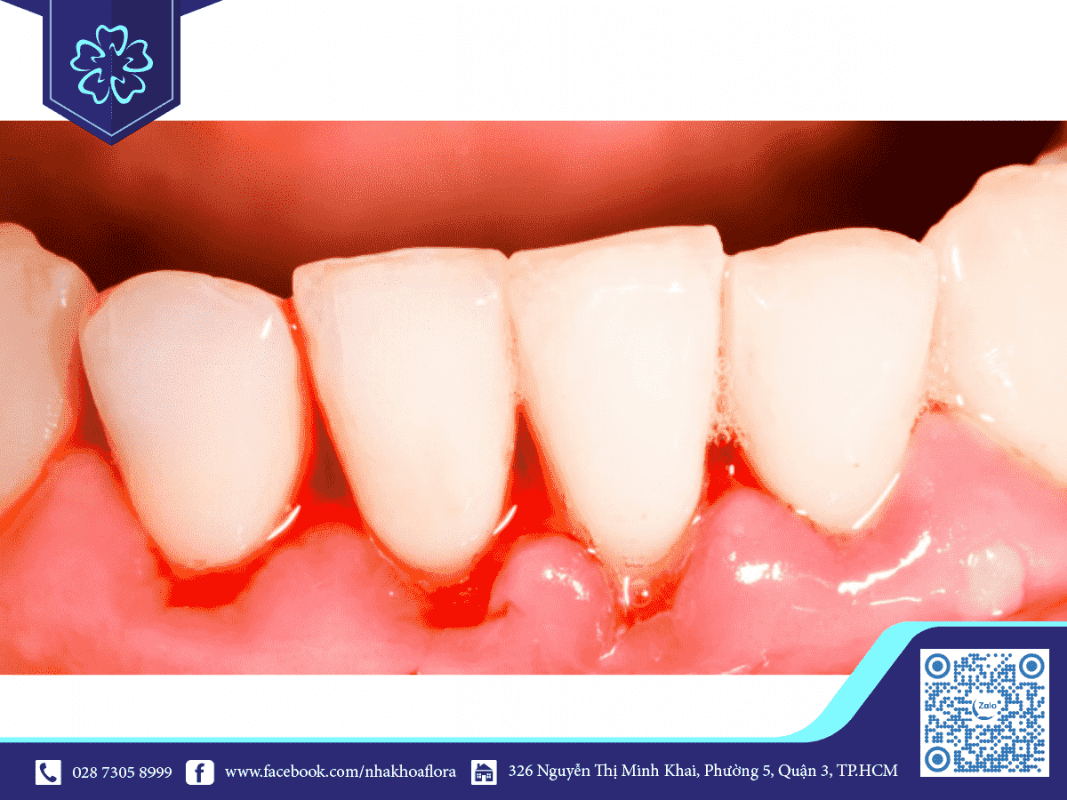 Chảy máu chân răng thường xuyên là bệnh viêm nướu Chảy máu chân răng thường xuyên là bệnh viêm nướu