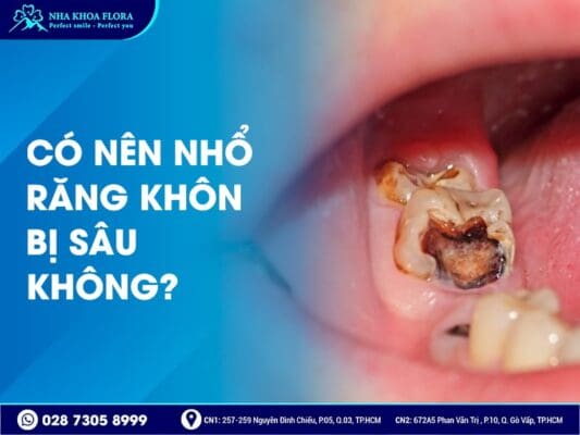 Có nên nhổ răng khôn - ảnh 3 Có nên nhổ răng khôn - ảnh 3