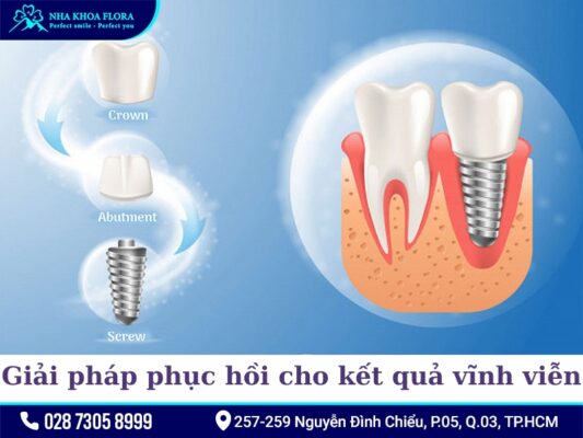 Lợi ích của trồng răng Implant - ảnh 2 Lợi ích của trồng răng Implant - ảnh 2