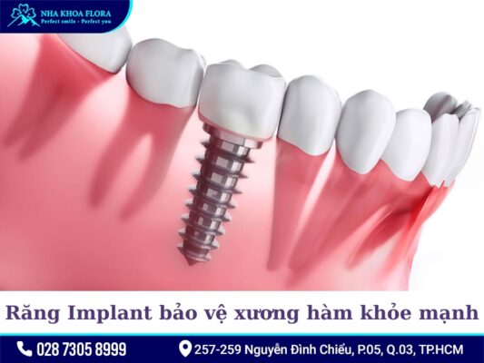 Lợi ích của trồng răng Implant - ảnh 4 Lợi ích của trồng răng Implant - ảnh 4