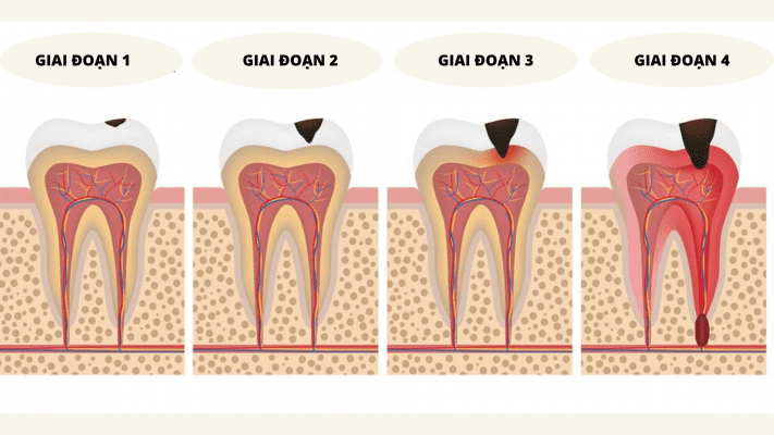 chua-dau-rang-sau-tai-nha chữa đau răng sâu tại nhà