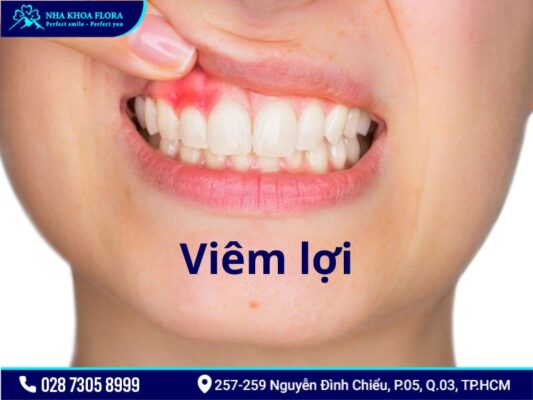 bệnh răng miệng - ảnh 2 bệnh răng miệng - ảnh 2