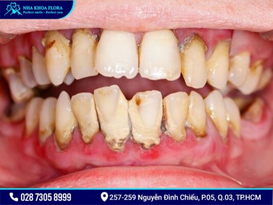 bệnh răng miệng - ảnh 4 bệnh răng miệng - ảnh 4