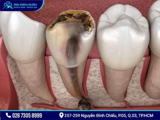bệnh răng miệng - ảnh 5 bệnh răng miệng - ảnh 5