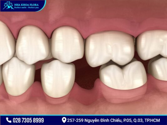 bệnh răng miệng - ảnh 6 bệnh răng miệng - ảnh 6