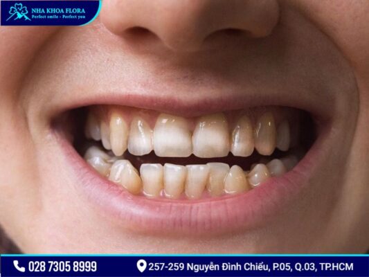 bệnh răng miệng - ảnh 7 bệnh răng miệng - ảnh 7