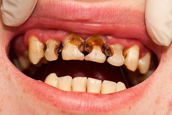 rang-sau-de-lau răng sâu để lâu