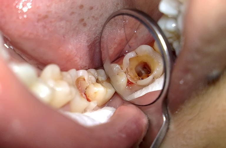 rang-sau-loi-thit răng sâu lồi thịt