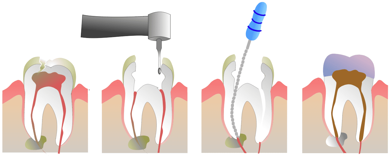 sau-rang-so-8 Sâu răng số 8 thi nên làm gì? Chữa trị hay Nhổ bỏ 2