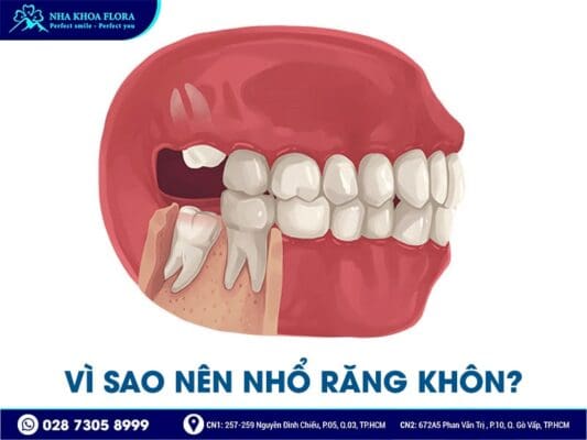 nhổ răng khôn có đau không - ảnh 1 nhổ răng khôn có đau không - ảnh 1
