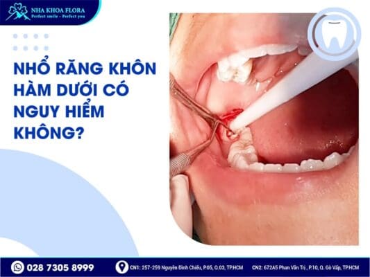 nhổ răng khôn hàm dưới - ảnh 1 nhổ răng khôn hàm dưới - ảnh 1