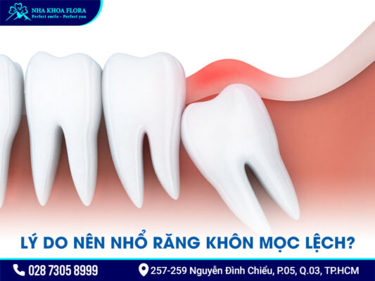 nhổ răng khôn mọc lệch - ảnh 1 nhổ răng khôn mọc lệch - ảnh 1
