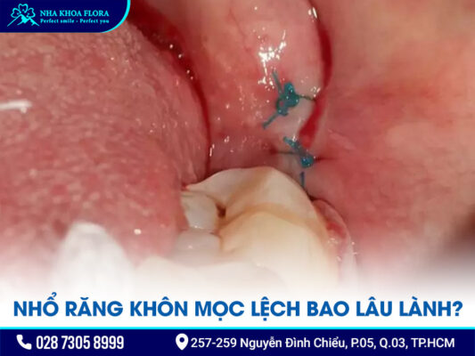 nhổ răng khôn mọc lệch - ảnh 3 nhổ răng khôn mọc lệch - ảnh 3