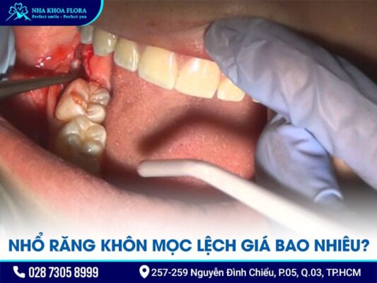 nhổ răng khôn mọc lệch - ảnh 4 nhổ răng khôn mọc lệch - ảnh 4