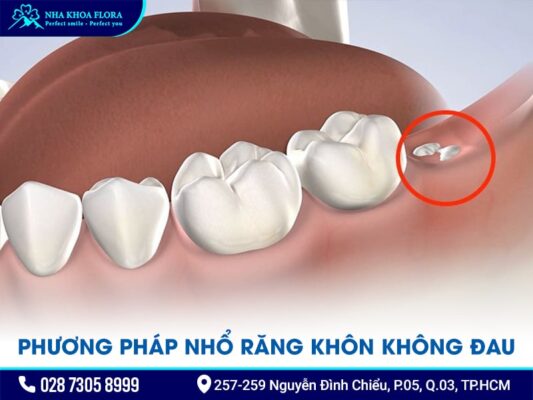 Phương pháp nhổ răng khôn không đau - ảnh 2 Phương pháp nhổ răng khôn không đau - ảnh 2