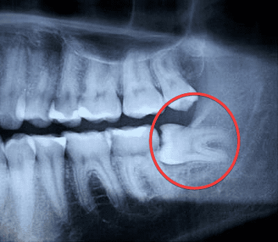 sau-rang-so-8 Sâu răng số 8 thi nên làm gì? Chữa trị hay Nhổ bỏ 3