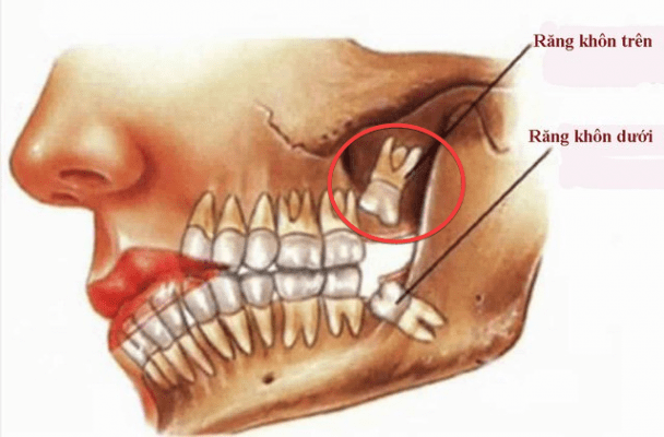 rang-sau-so-8-ham-tren răng sâu số 8 hàm trên