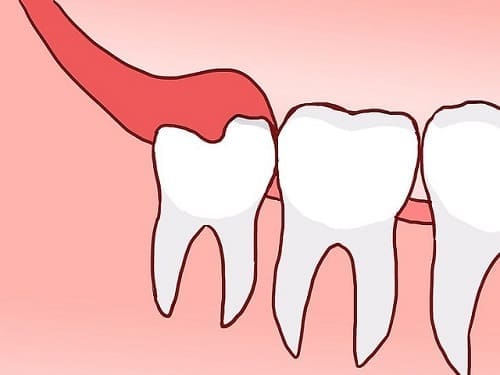 rang-sau-so-8-ham-tren răng sâu số 8 hàm trên