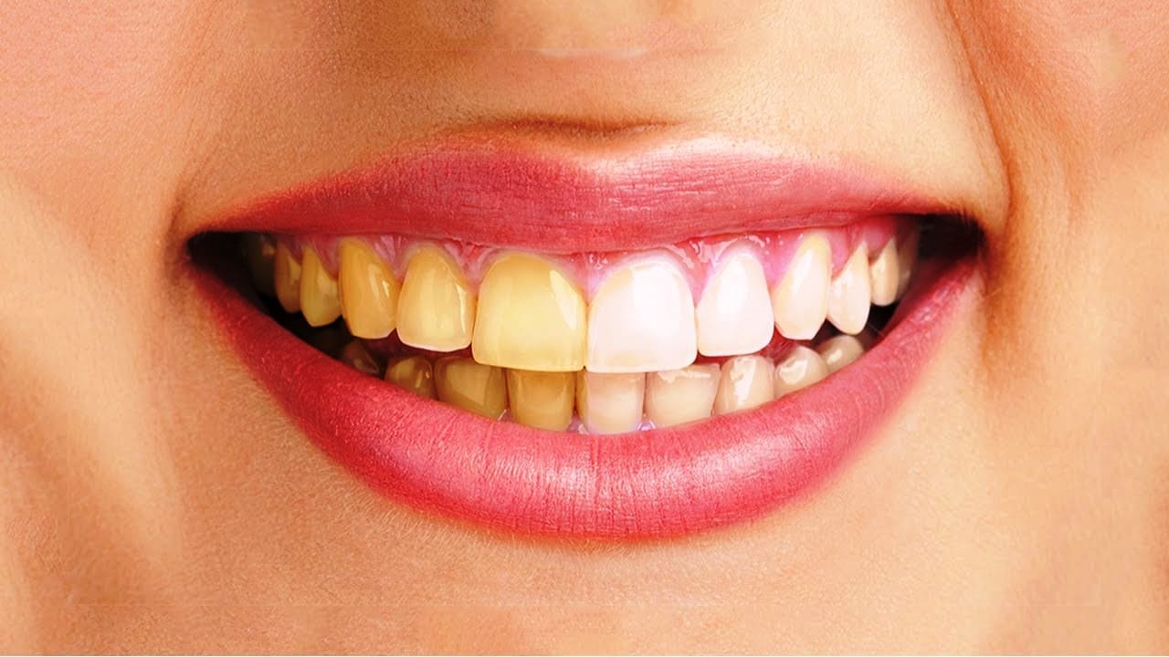 rang-sau-loi-thit răng sâu lồi thịt dẫn đến răng vàng ố