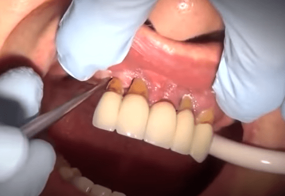 dieu-tri-viem-nha-chu điều trị viêm nha chu