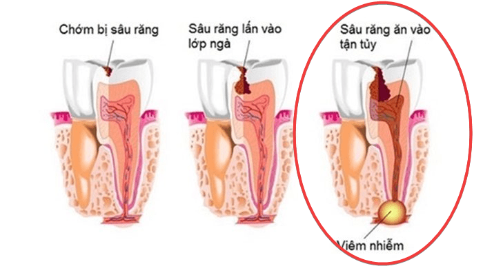 nho-rang-sau-ham-duoi nhổ răng sâu hàm dưới