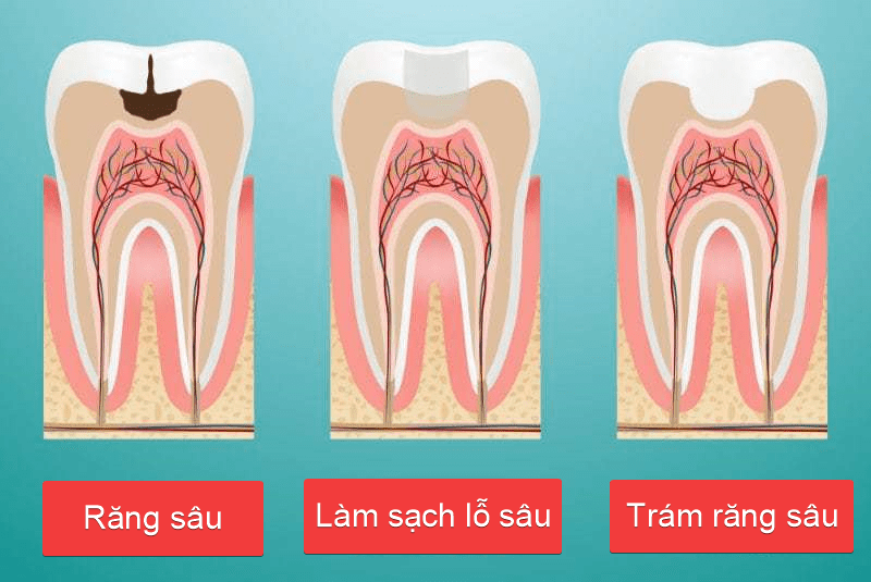sau-rang-so-8 Sâu răng số 8 thi nên làm gì? Chữa trị hay Nhổ bỏ 1