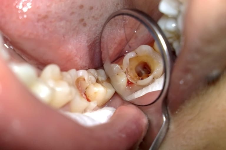 nho-rang-sau-ham-duoi nhổ răng sâu hàm dưới