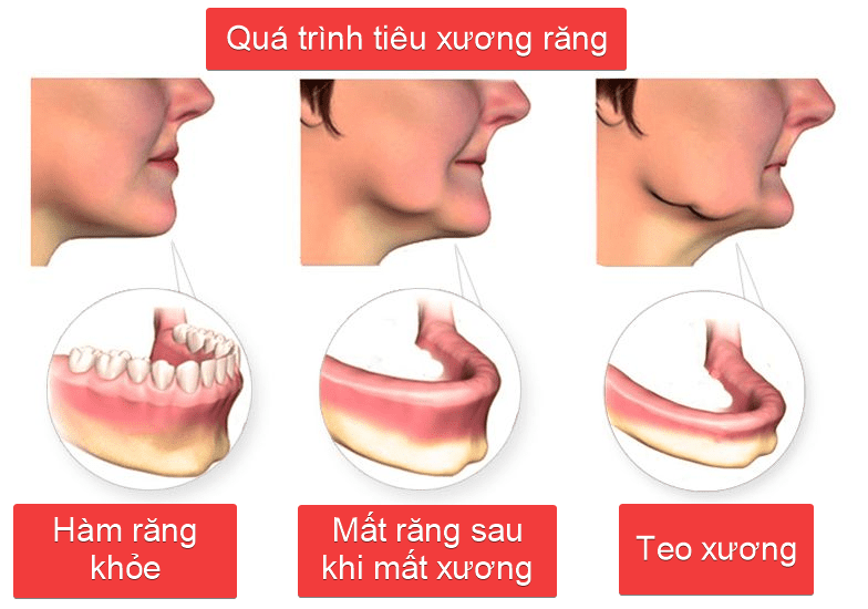 dieu-tri-viem-nha-chu điều trị viêm nha chu