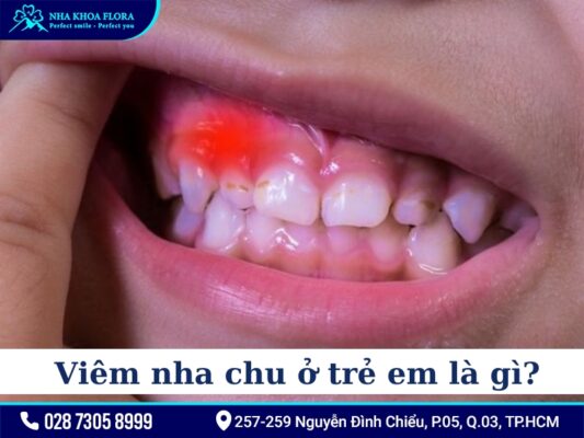 Viêm nha chu ở trẻ em - ảnh 1 Viêm nha chu ở trẻ em - ảnh 1