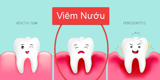 viem-nuou-va-viem-nha-chu viêm nướu và viêm nha chu