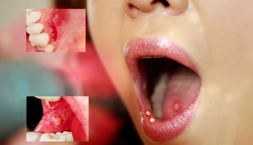sau-rang-so-8 Sâu răng số 8 thi nên làm gì? Chữa trị hay Nhổ bỏ 5