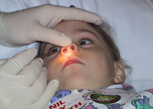 Bé bị hôi miệng do các dị vật trong mũi Bé bị hôi miệng do các dị vật trong mũi