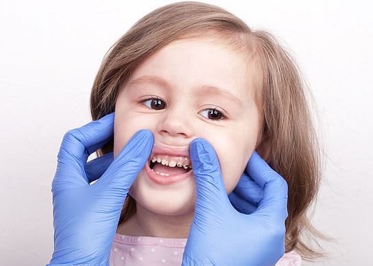 Bé bị hôi miệng do sâu răng (ảnh minh họa) Bé bị hôi miệng do sâu răng (ảnh minh họa)
