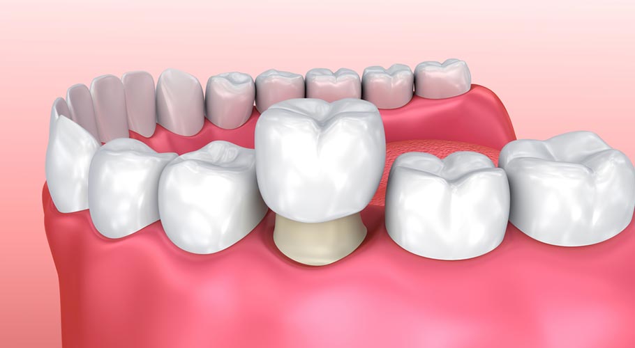 bien-chung-boc-rang-su biến chứng bọc răng sứ