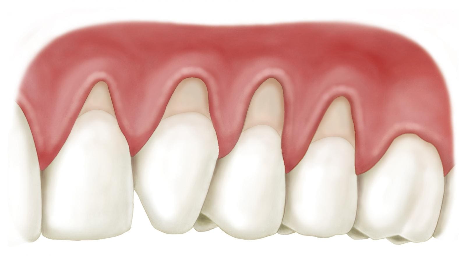 bien-chung-boc-rang-su biến chứng bọc răng sứ