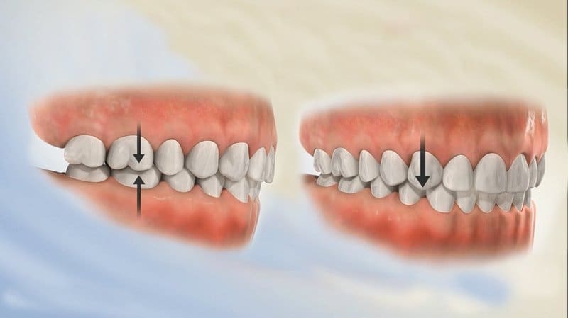 bien-chung-boc-rang-su biến chứng bọc răng sứ