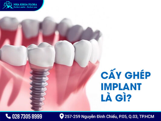 Nên cấy ghép Implant hay dùng hàm tháo lắp? - ảnh 1 Nên cấy ghép Implant hay dùng hàm tháo lắp? - ảnh 1