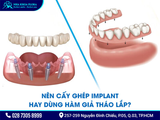 Nên cấy ghép Implant hay dùng hàm tháo lắp? - ảnh 3 Nên cấy ghép Implant hay dùng hàm tháo lắp? - ảnh 3