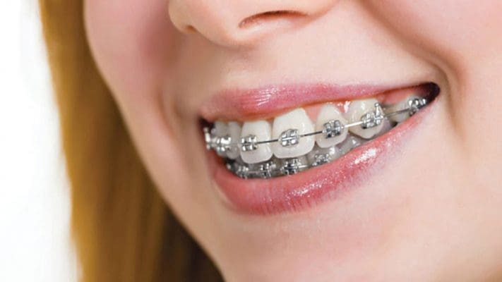 Nhổ răng khôn với mục đích thẩm mỹ như niềng răng sẽ không được bào hiểm y tế chi trả (ảnh minh họa) Nhổ răng khôn với mục đích thẩm mỹ như niềng răng sẽ không được bào hiểm y tế chi trả (ảnh minh họa)
