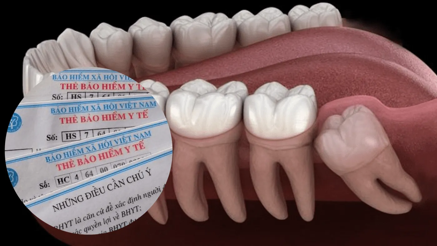 Nhổ răng khôn có được bảo hiểm y tế chi trả không? (ảnh minh họa)